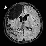 Affected brain tissue